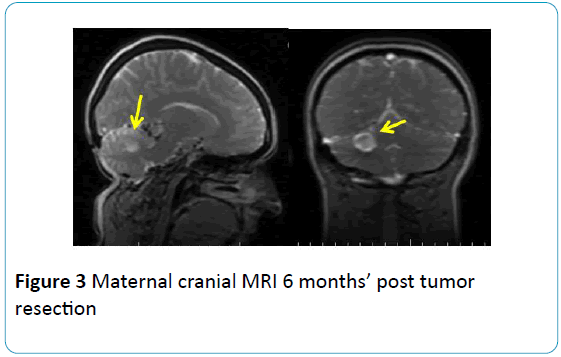 gynecology-obstetrics-Maternal-cranial-tumor