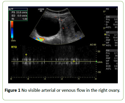 gynecology-obstetrics-No-visible-arterial-venous-flow