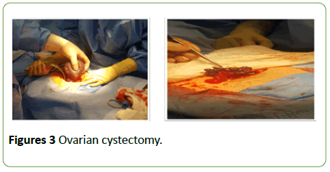 gynecology-obstetrics-Ovarian-cystectomy
