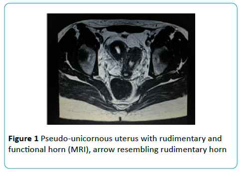 gynecology-obstetrics-Pseudo-unicornous-uterus