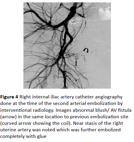 gynecology-obstetrics-Right-internal-iliac