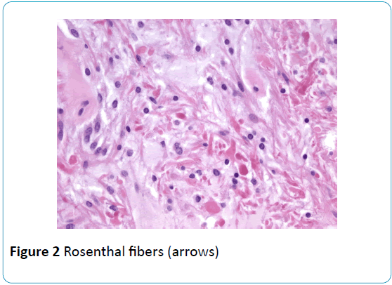 gynecology-obstetrics-Rosenthal-fibers-arrows
