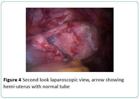 gynecology-obstetrics-Second-look-laparoscopic-view
