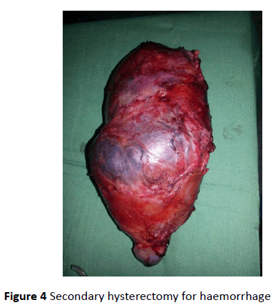 gynecology-obstetrics-Secondary-hysterectomy