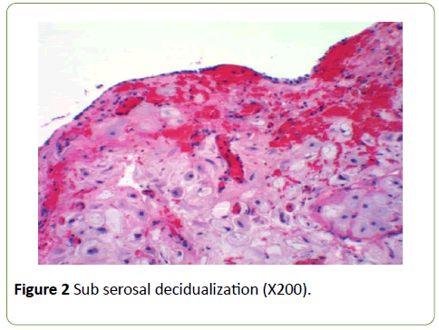 gynecology-obstetrics-Sub-serosal-decidualization