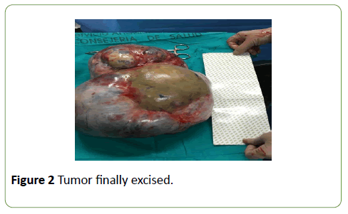 gynecology-obstetrics-Tumor-finally-excised