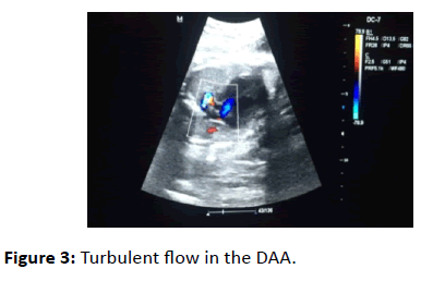 gynecology-obstetrics-Turbulent-flow