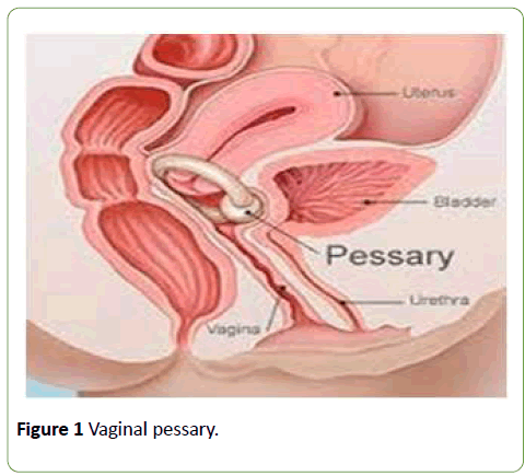 Pregnant Prolapse