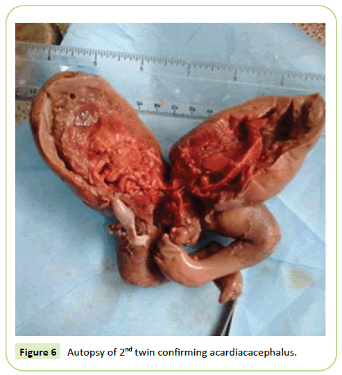 gynecology-obstetrics-acardiacacephalus