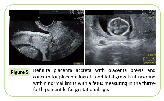 gynecology-obstetrics-accreta