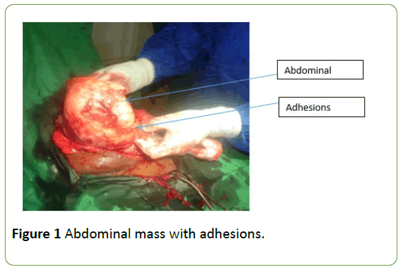 gynecology-obstetrics-adhesions