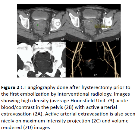 gynecology-obstetrics-angiography-hysterectomy-prior