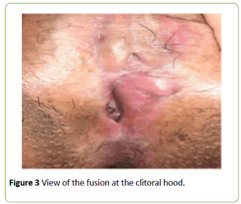 gynecology-obstetrics-clitoral-hood