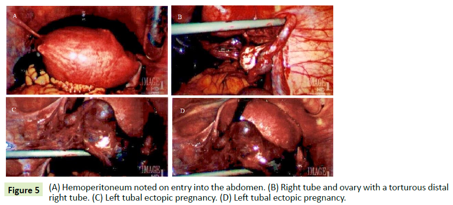 gynecology-obstetrics-ectopic-pregnancy