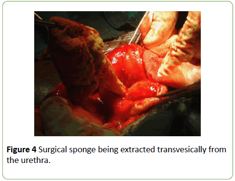 gynecology-obstetrics-extracted-transvesically-urethra