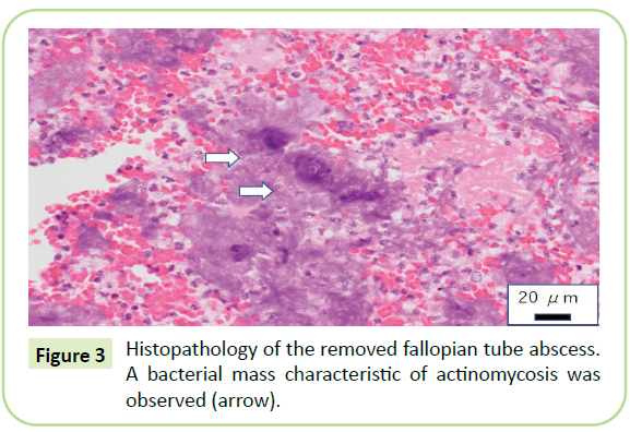 gynecology-obstetrics-fallopian-tube