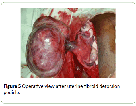 gynecology-obstetrics-fibroid-detorsion