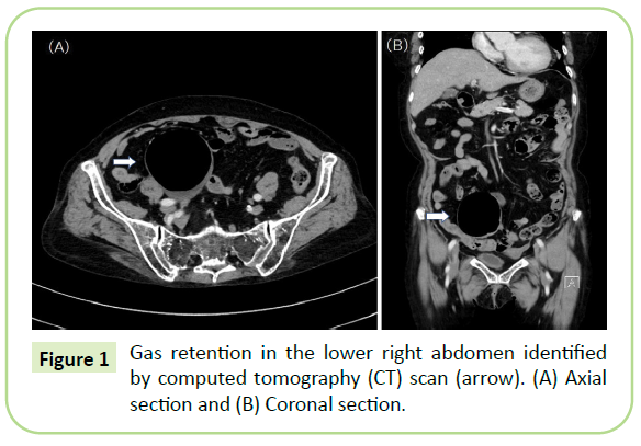 gynecology-obstetrics-gas-retention