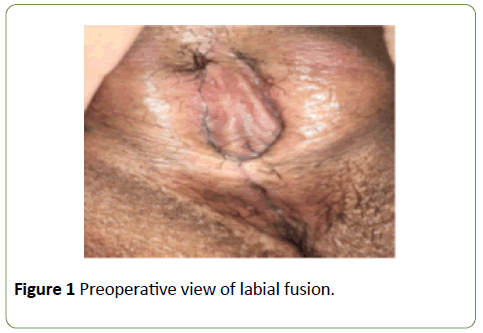 gynecology-obstetrics-labial-fusion
