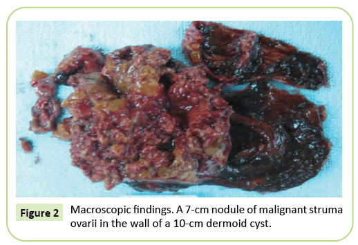 gynecology-obstetrics-malignant