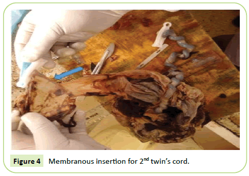 gynecology-obstetrics-membranous-insertion