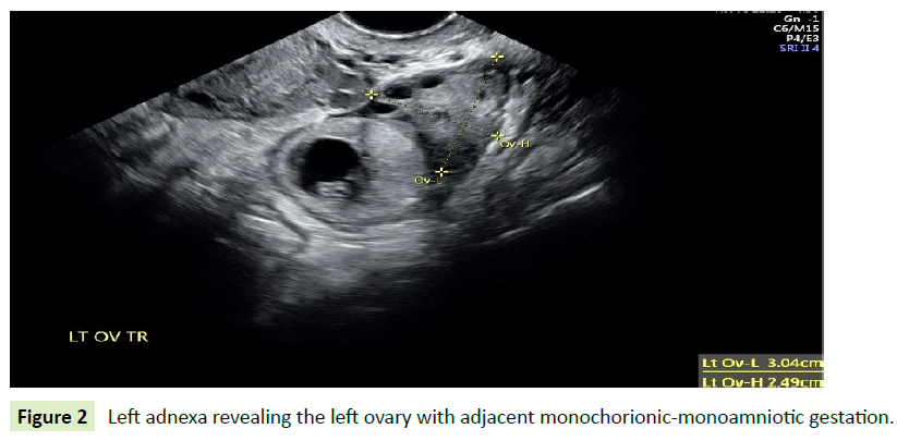 gynecology-obstetrics-monoamniotic-gestation