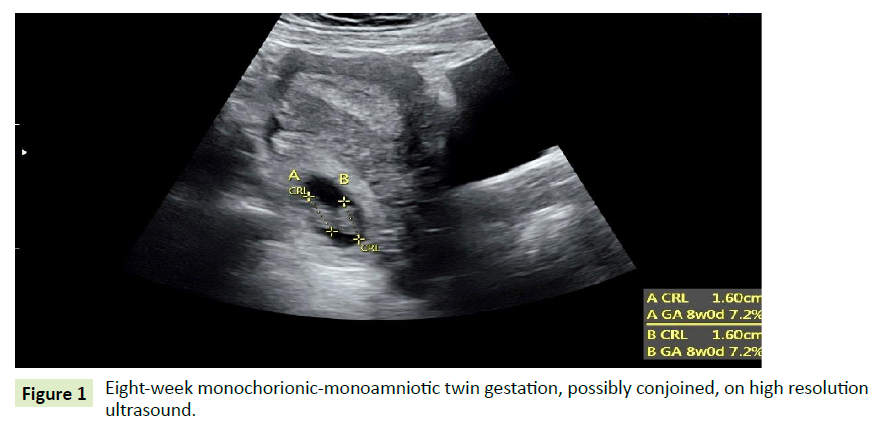 gynecology-obstetrics-monoamniotic-twin