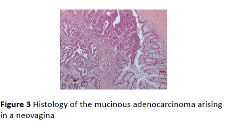 gynecology-obstetrics-mucinous-adenocarcinoma
