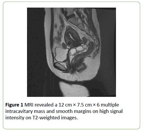 gynecology-obstetrics-multiple-intracavitary-mass-smooth-margins