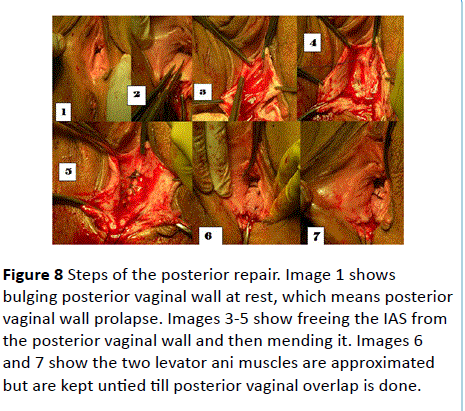 gynecology-obstetrics-muscles-approximated