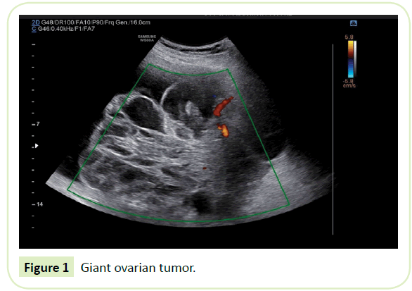 gynecology-obstetrics-ovarian-tumor