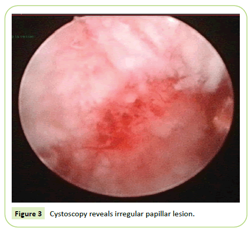 gynecology-obstetrics-papillar-lesion