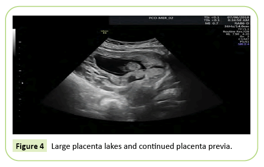 gynecology-obstetrics-placenta
