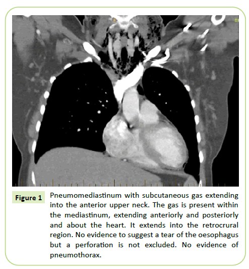 gynecology-obstetrics-pneumomediastinum