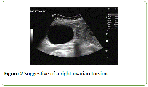 gynecology-obstetrics-right-ovarian-torsion