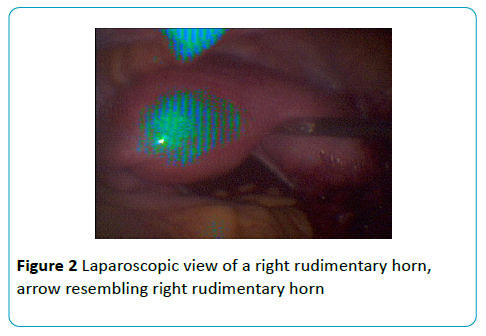 gynecology-obstetrics-right-rudimentary-horn