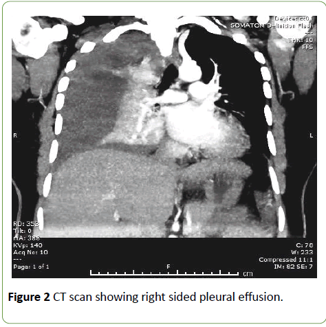 gynecology-obstetrics-right-sided-pleural-effusion