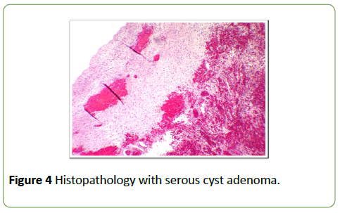 gynecology-obstetrics-serous-cyst-adenoma