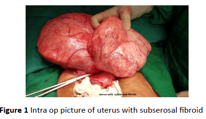 gynecology-obstetrics-subserosal-fibroid