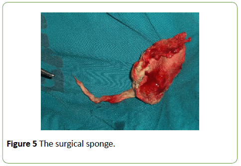 gynecology-obstetrics-surgical-sponge