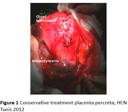 gynecology-obstetrics-treatment-placenta
