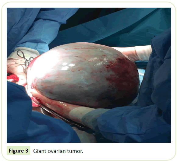 gynecology-obstetrics-tumor