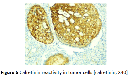 gynecology-obstetrics-tumor-cells