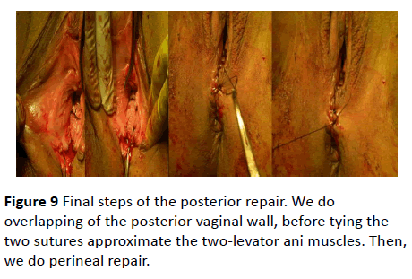 gynecology-obstetrics-two-levator-ani-muscles
