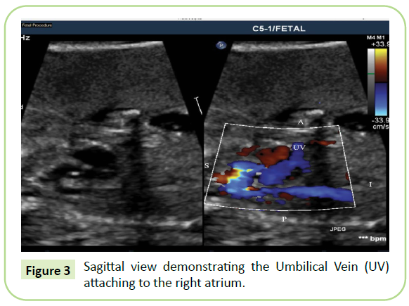 gynecology-obstetrics-umbilical-vein