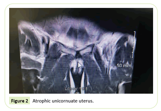 gynecology-obstetrics-unicornuate