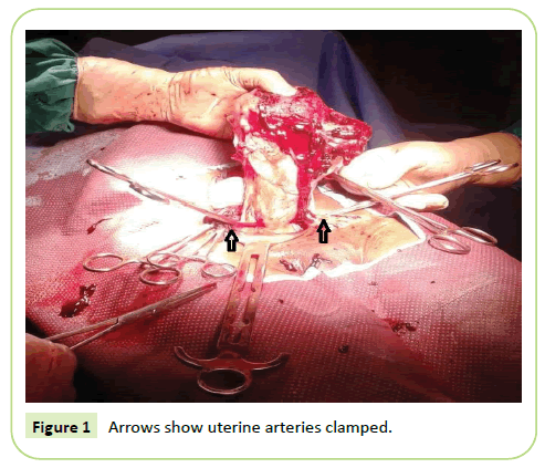 gynecology-obstetrics-uterine-arteries-clamped