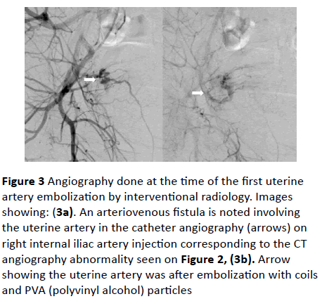 gynecology-obstetrics-uterine-artery-embolization