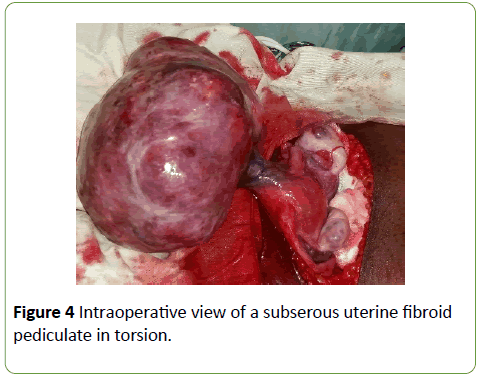 gynecology-obstetrics-uterine-fibroid