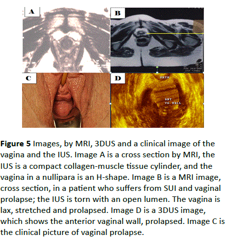 gynecology-obstetrics-vaginal-prolapse